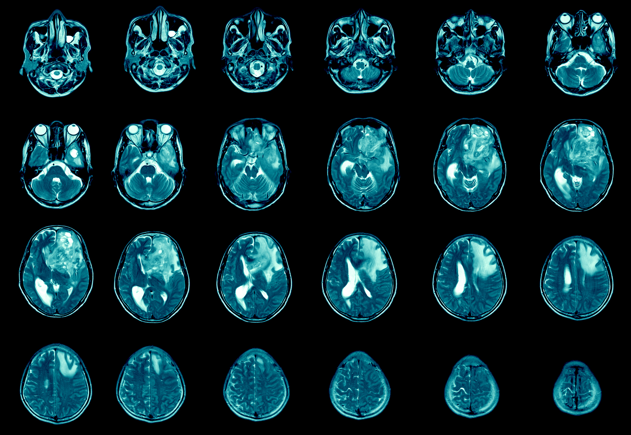 Recognizing the Symptoms of Terminal Brain Cancer