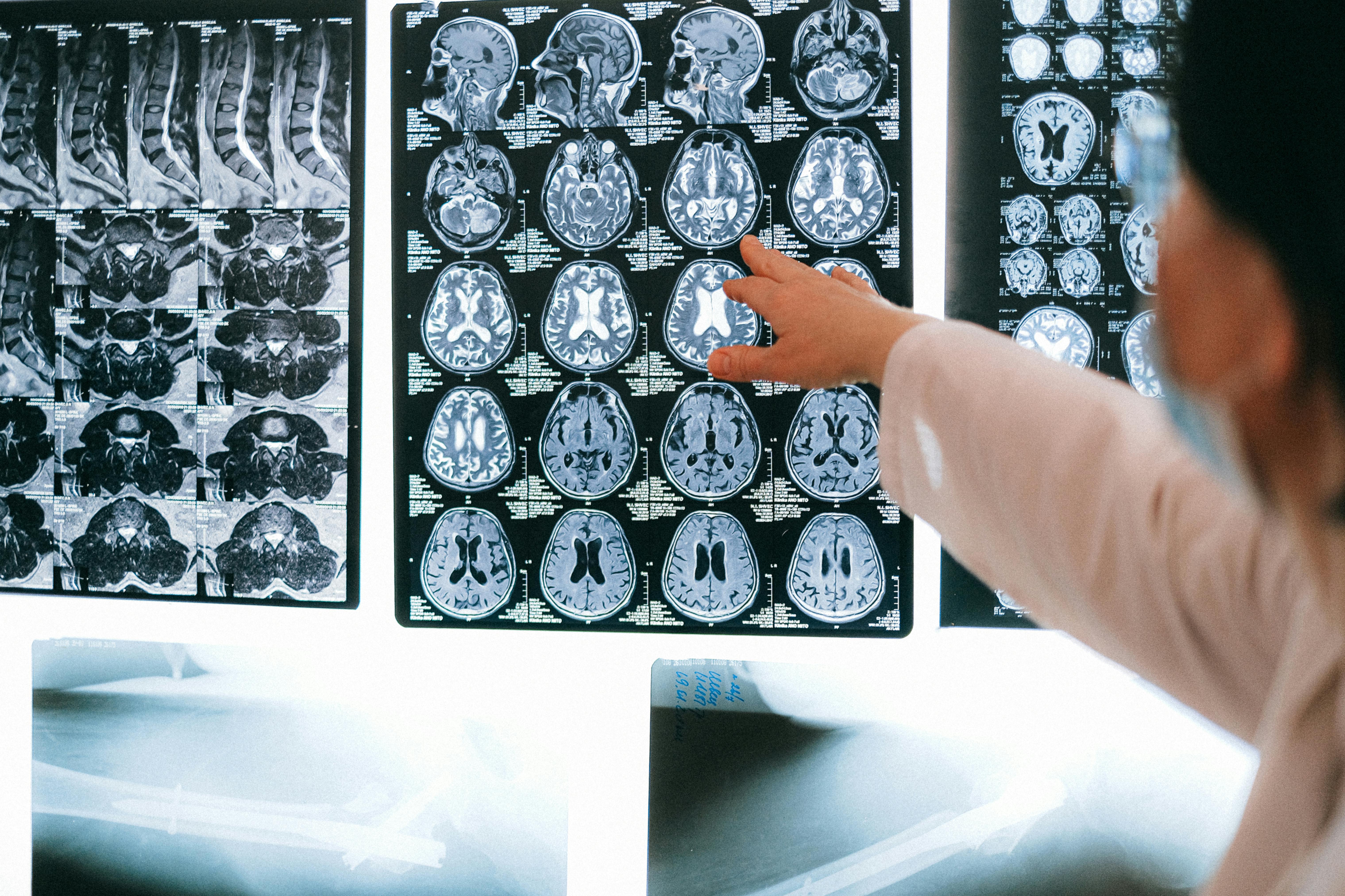 Doctor using an MRI to detect aneurysms
