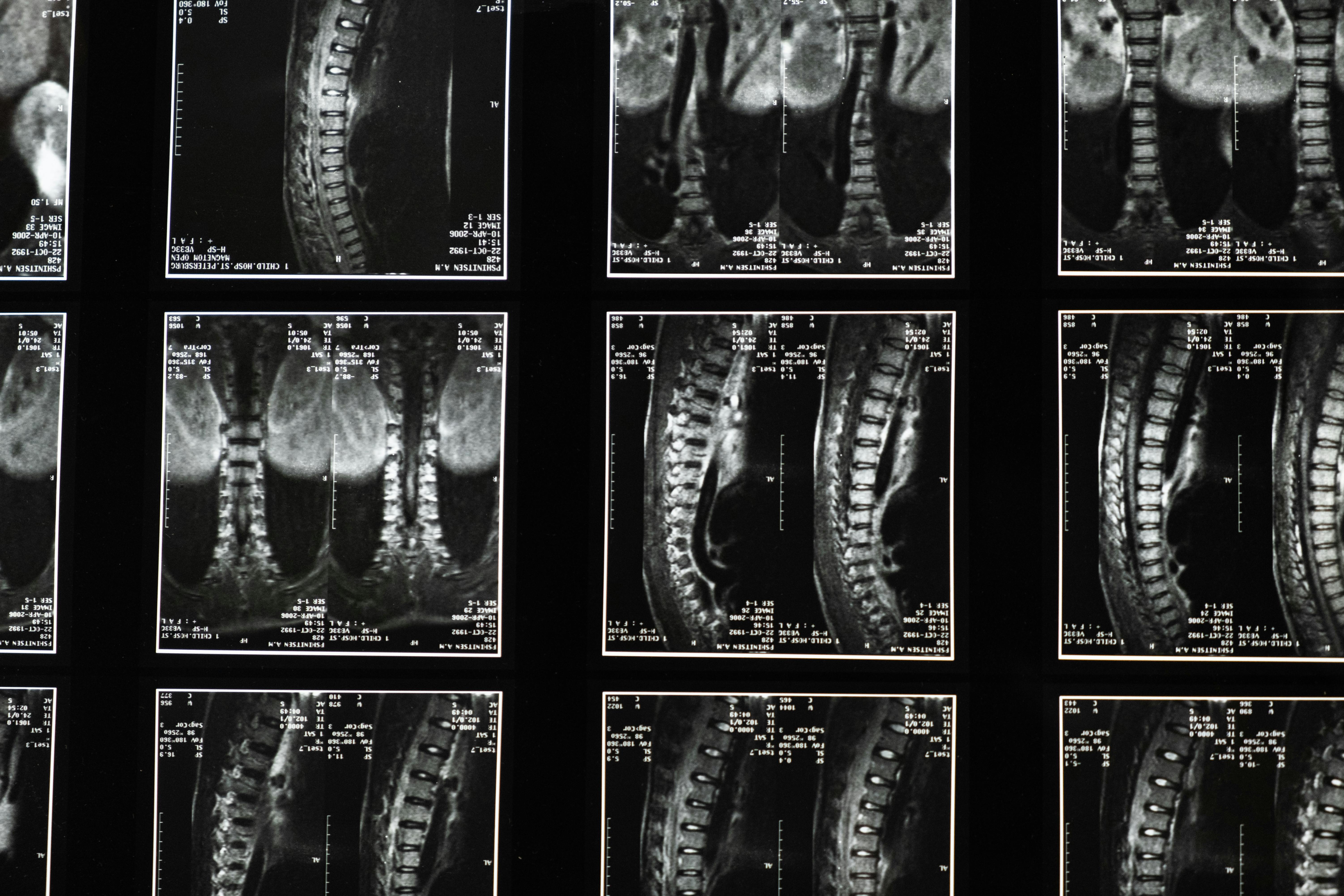 Group of MRI images of the spine.