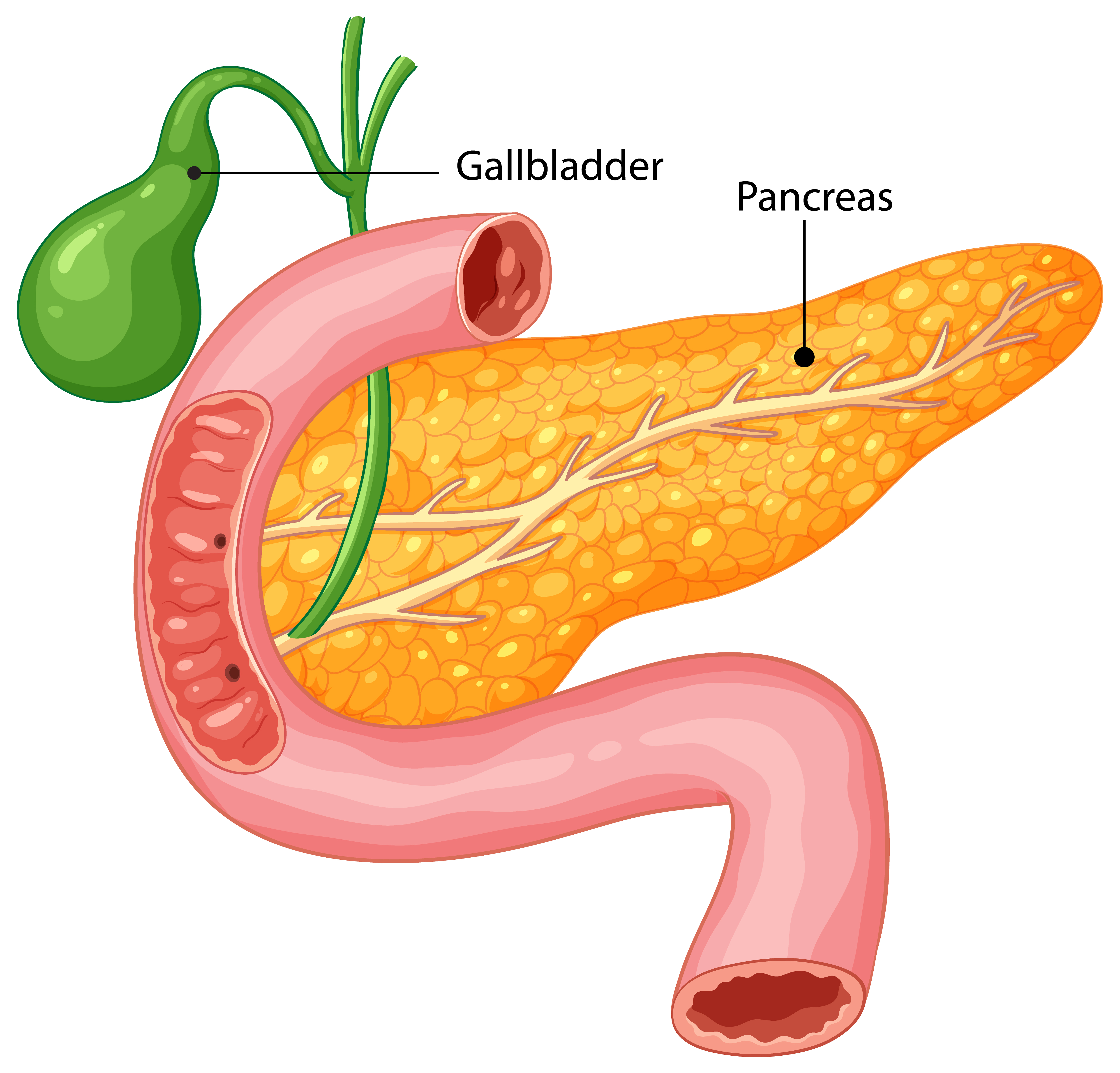 Anatomical diagram showing the relationship between the pancreas (orange) and gallbladder (green) with connecting ducts