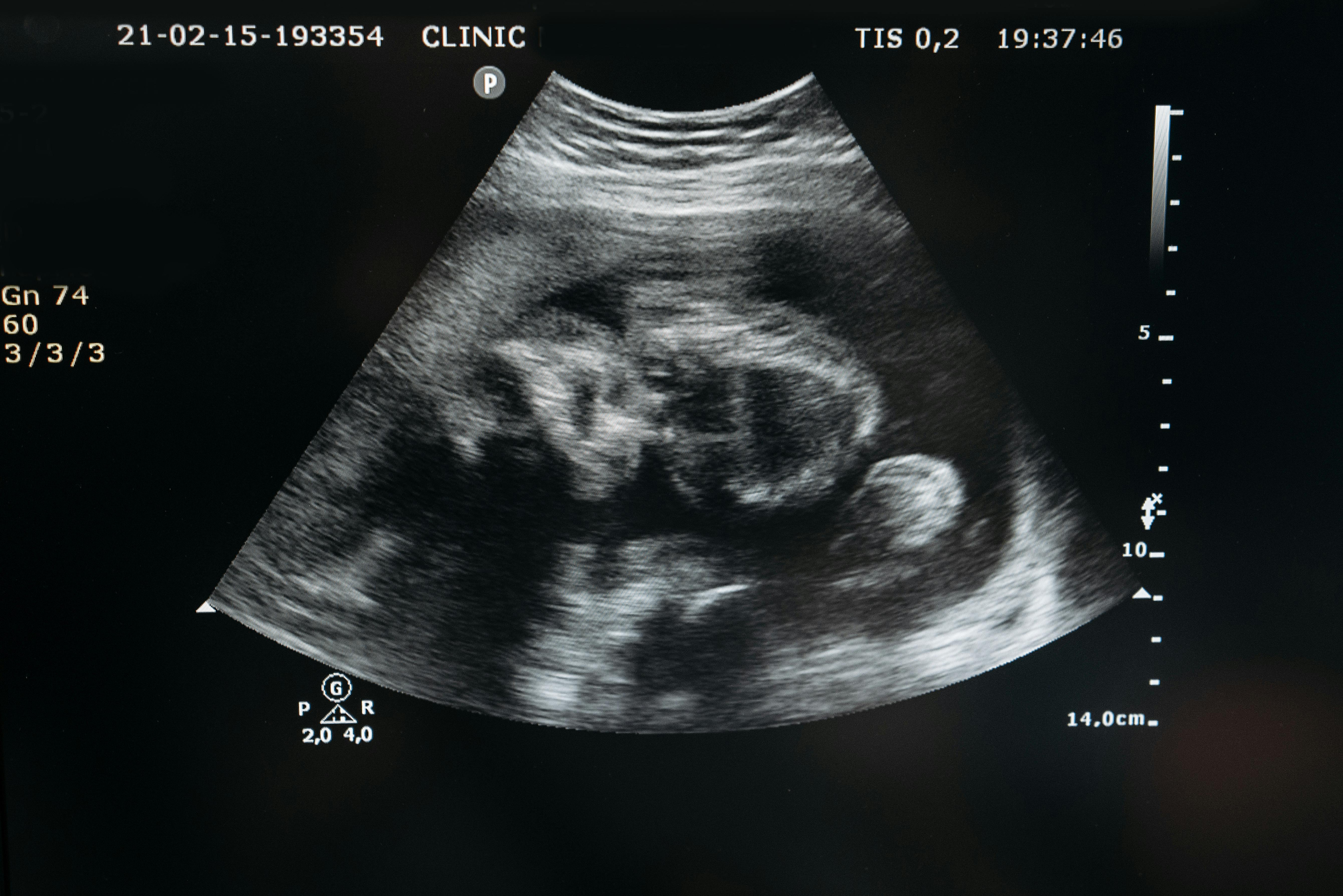 An ultrasound image of a fetus.