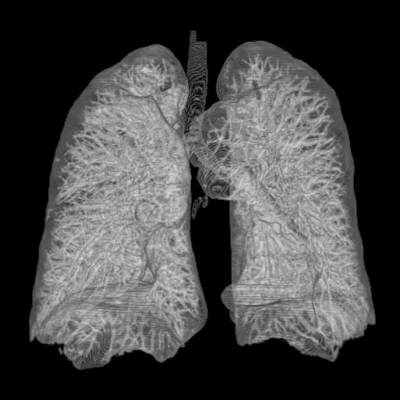 3D CT of lungs