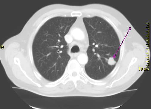 Lung cancer CT with small nodule.