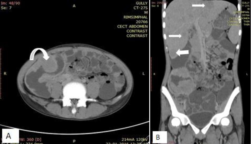 Abdominal CT of lymphoma. 