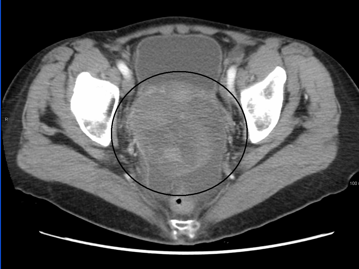 CT for ovarian cancer detection