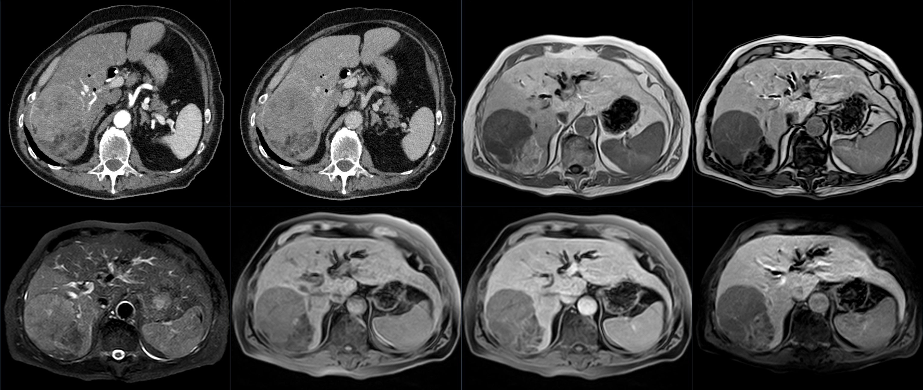 CT showing a liver tumor. Licensed under CC Atribution-Share Alike 4.0 International License.
