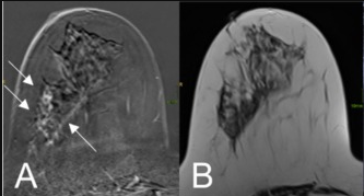 MRI scan of breast carcinoma