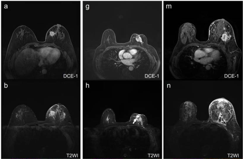 MRI scans of females with different types of breast cancer.