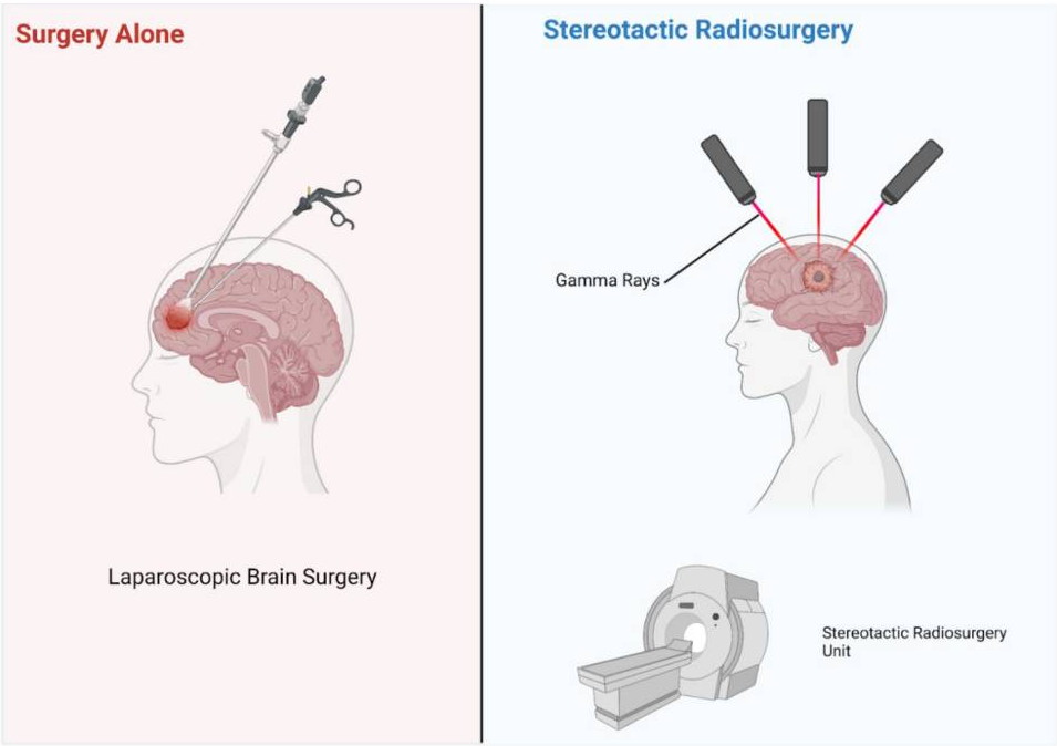 Stereotactic radiosurgery vs traditional surgery.