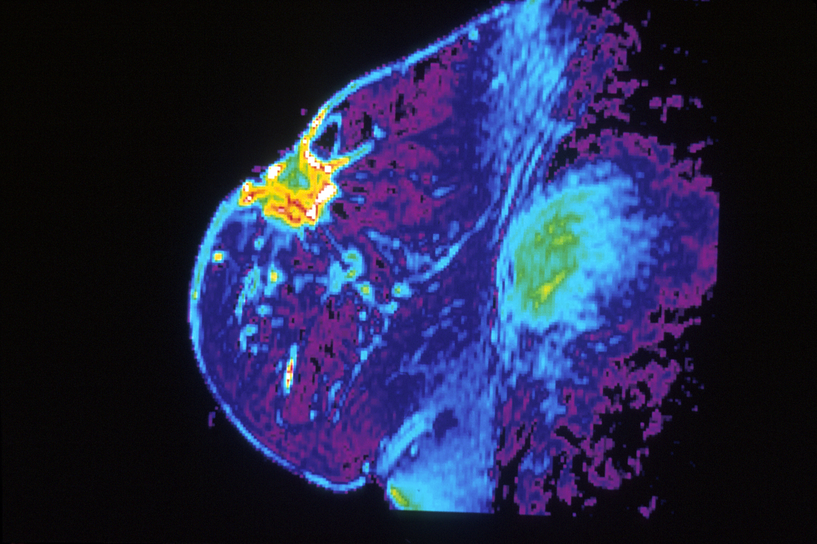 Color enhancement image of an MRI of a breast tumor