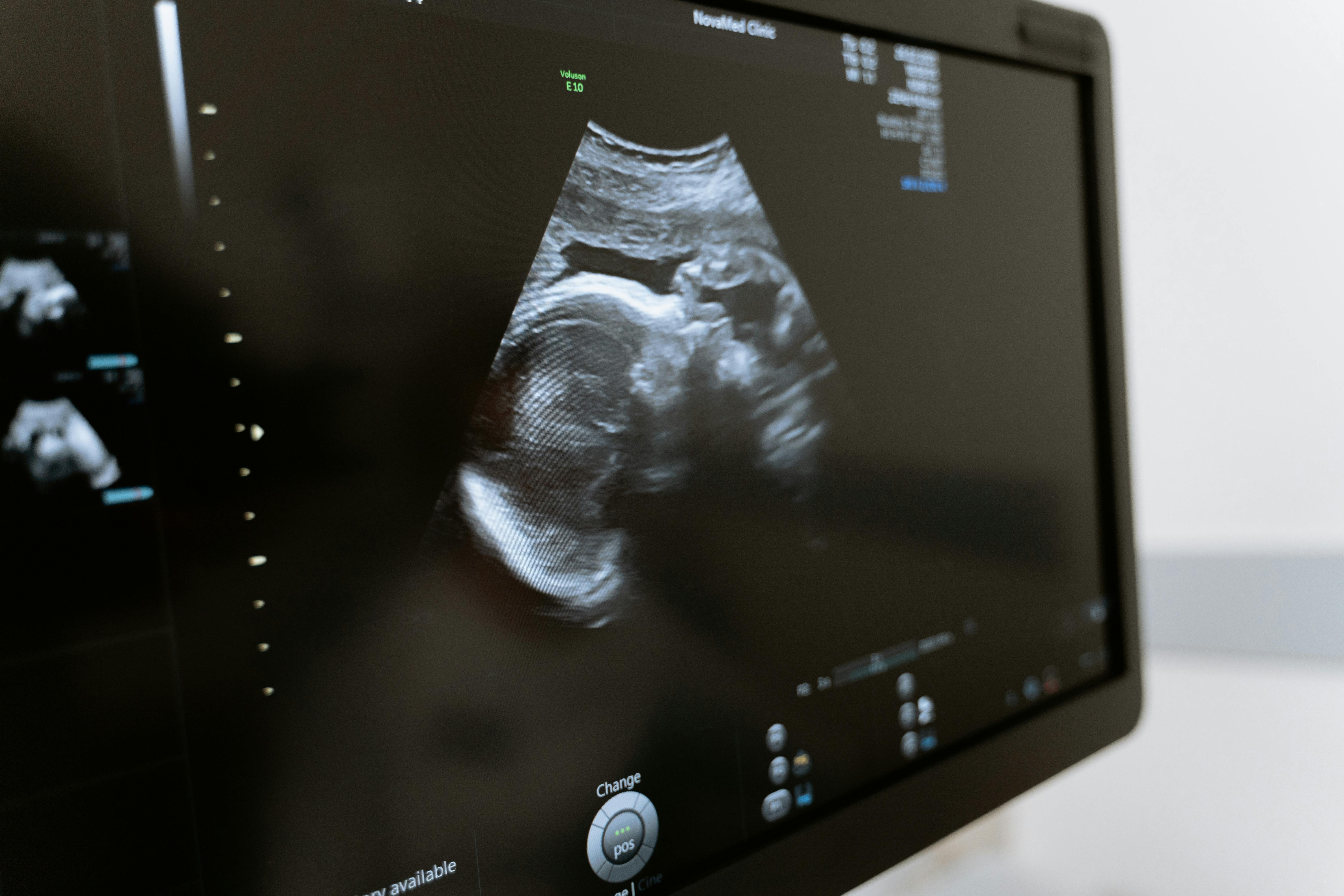 Example of when an ultrasound is better suited than a CT: during obstetrics scans.