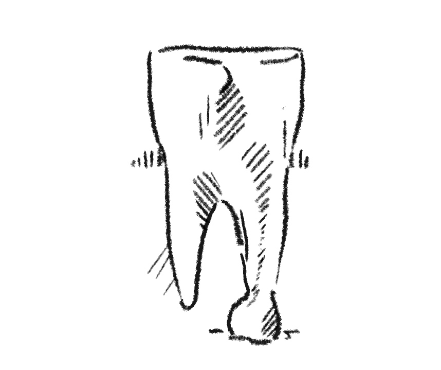 Image of tooth decay
