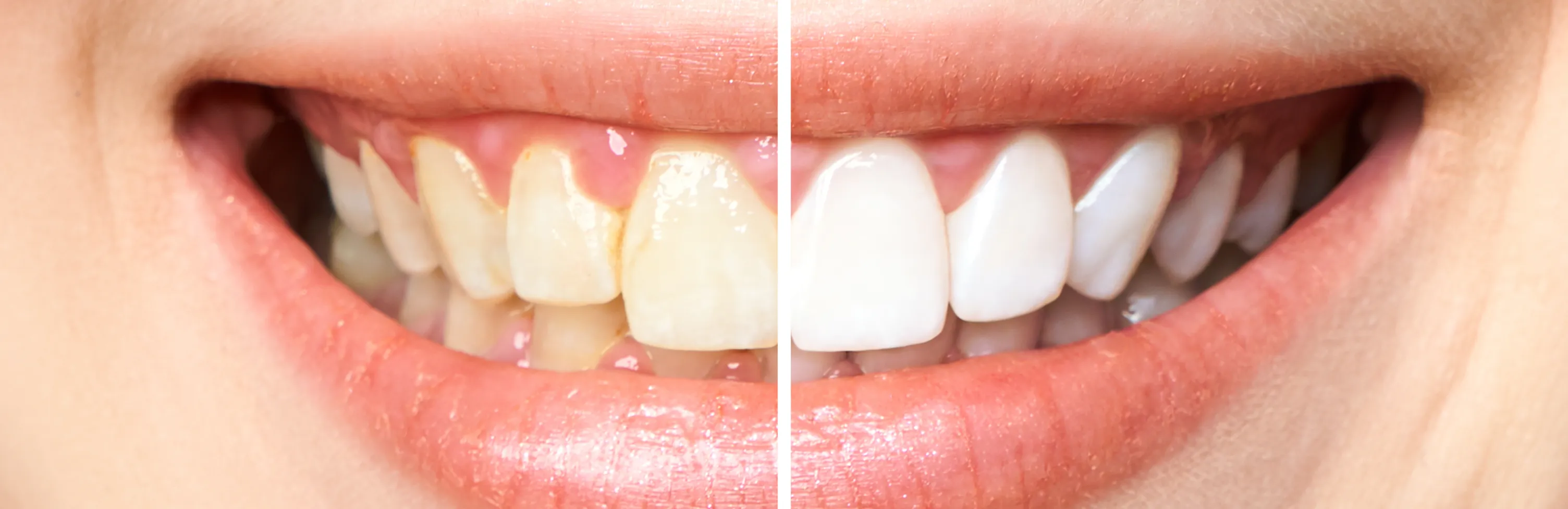 How Professional Teeth Whitening in Tampa Can Transform Your Smile