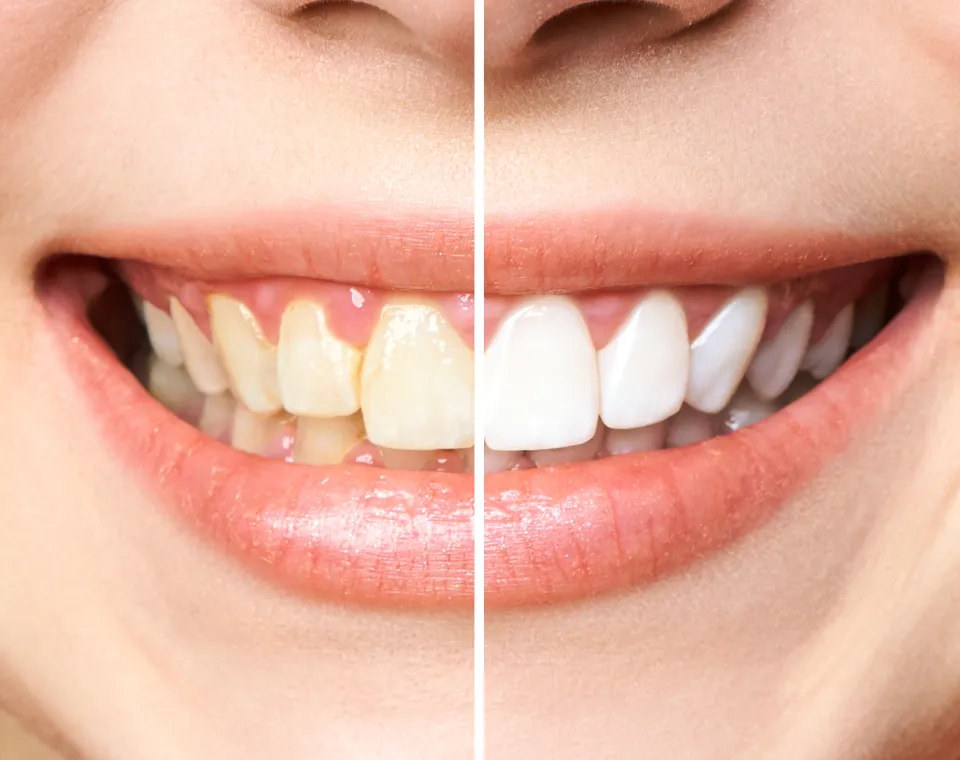 Teeth Whitening in Tampa FL: Your Complete Guide to a Brighter Smile