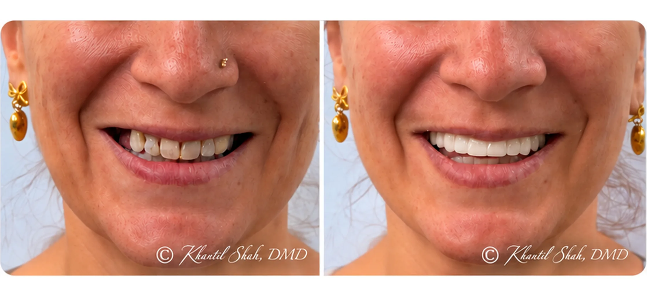 Before and after full-arch dental implant treatment at Signature Smiles of Tampa