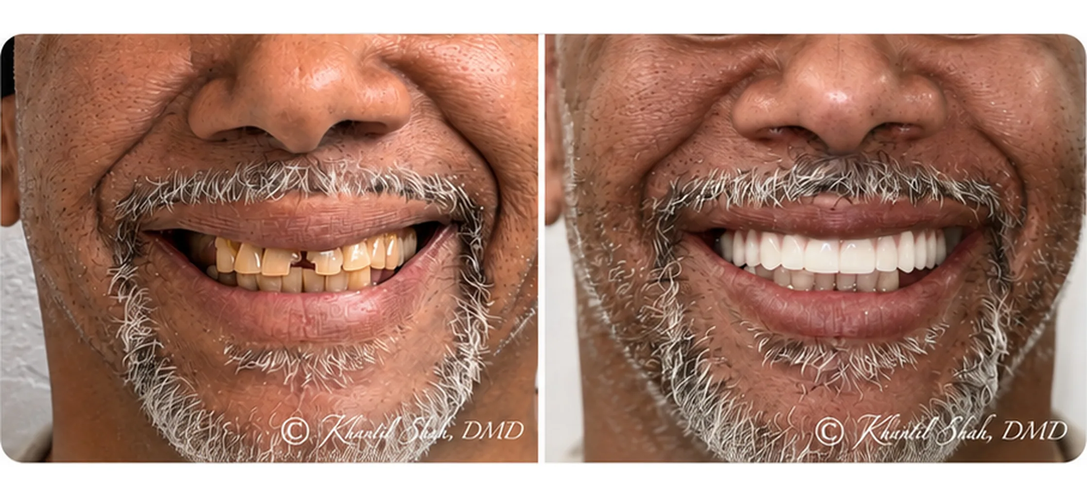 Before and after All-on-X implant smile restoration at Signature Smiles of Tampa