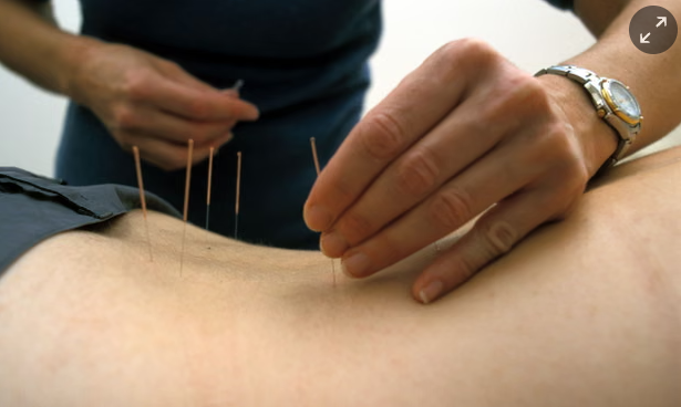 Acupuncture for herniated disc pain, Meridian ID