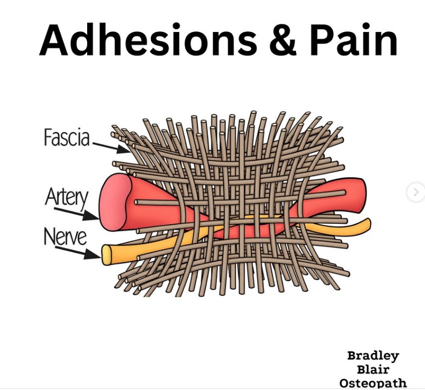 Adhesion Release Method for herniated disc guarding, Meridian ID