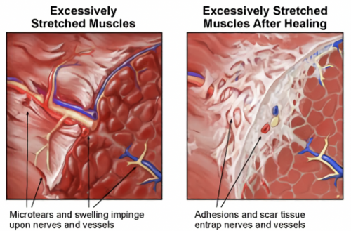 How scar tissue forms around and traps a nerve — patient education graphic