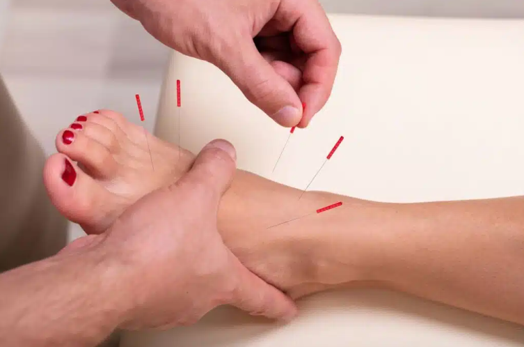 Acupuncture treatment for nerve pain and neuropathy — Eagle, ID clinic