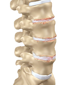 degeneration of the spine arthritis lumbar boise, idaho