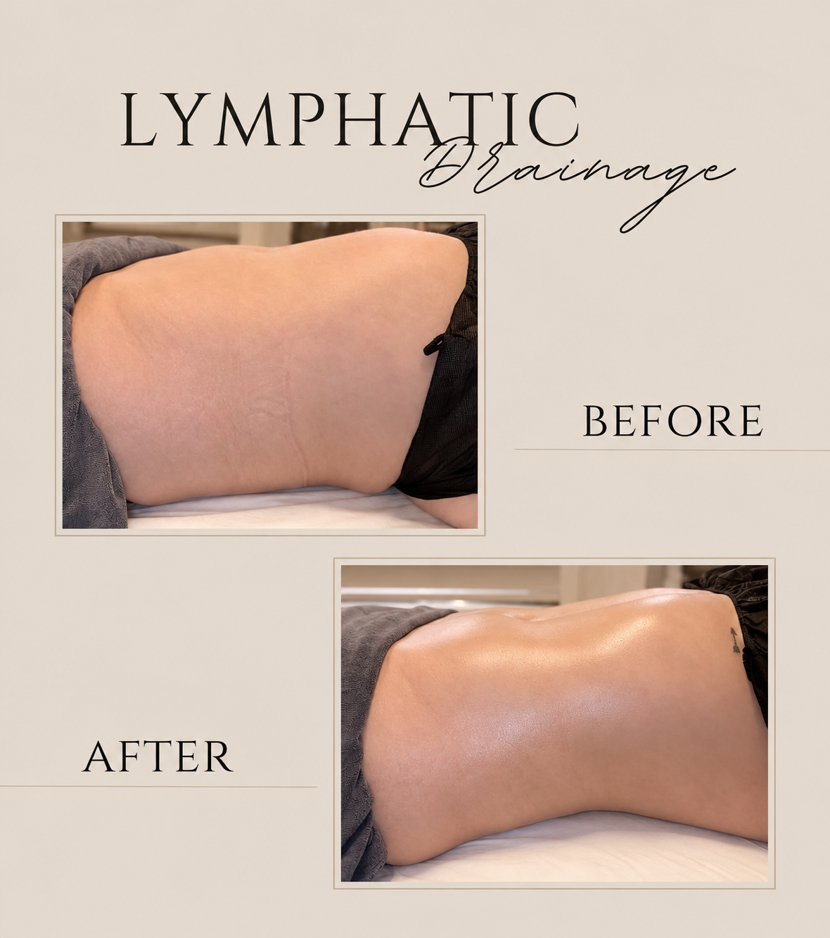 Lymphatic drainage before and after results on a client's abdomen at Sculpt Haus NYC