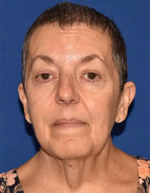 Facelift before photo, case 12959 - Cool Springs Plastic Surgery