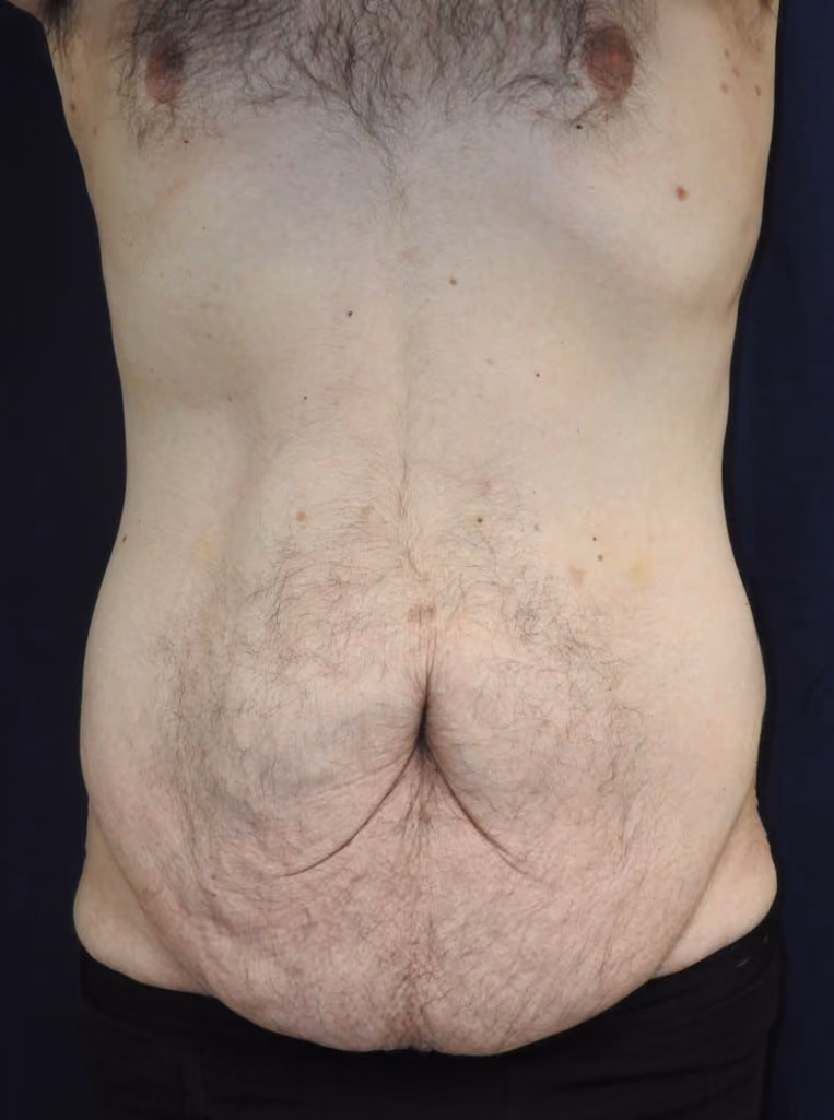 Tummy Tuck before photo, case 6474 - Cool Springs Plastic Surgery