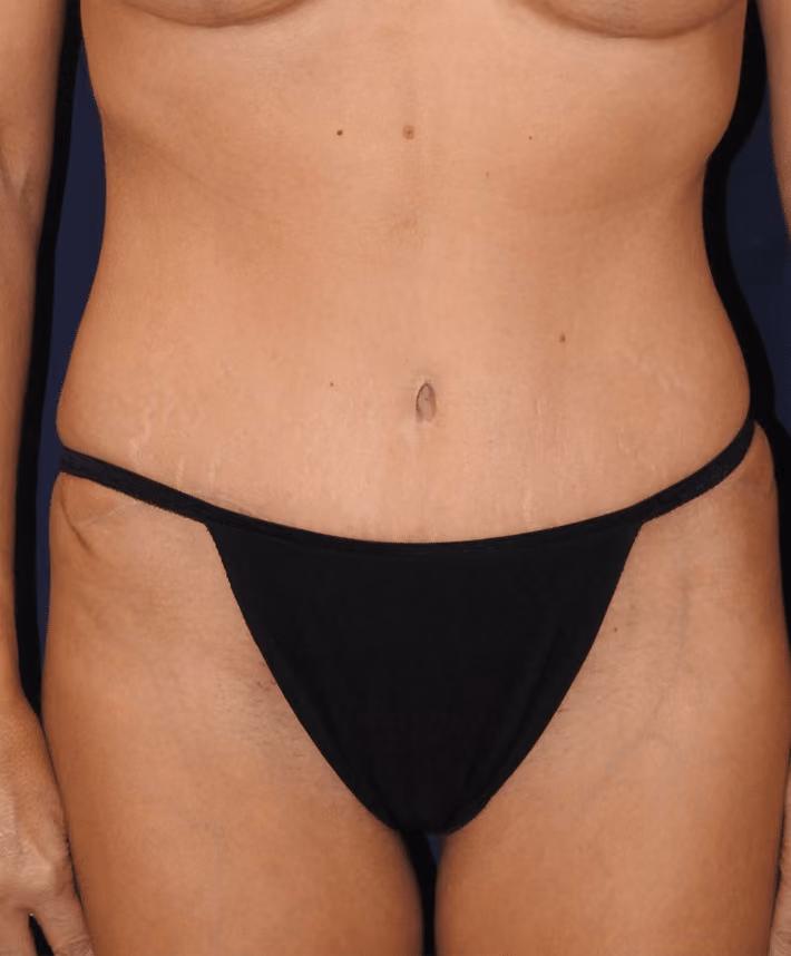 Tummy Tuck after photo, case 7029 - Cool Springs Plastic Surgery