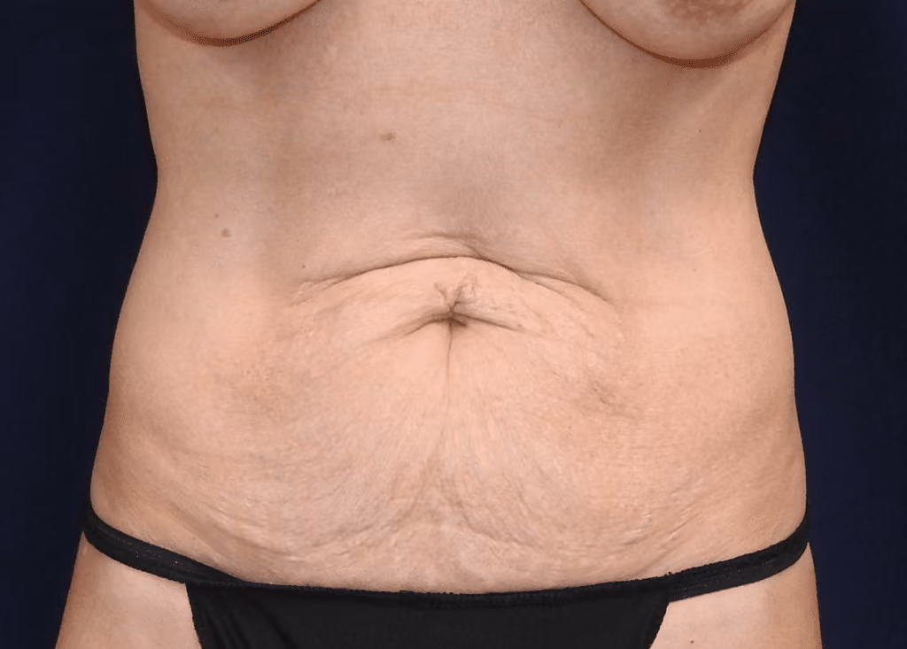 Tummy Tuck before photo, case 7154 - Cool Springs Plastic Surgery