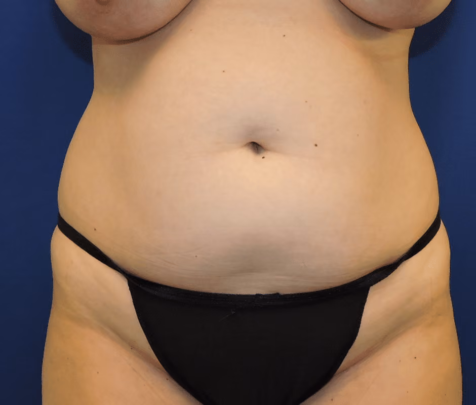 Tummy Tuck before photo, case 7568 - Cool Springs Plastic Surgery