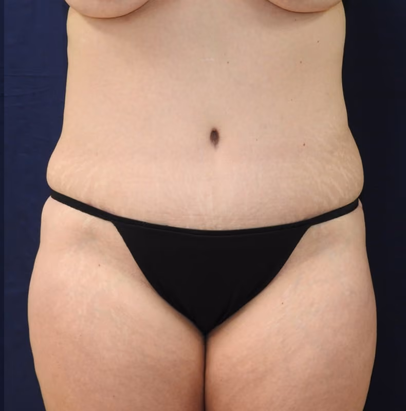 Tummy Tuck after photo, case 7648 - Cool Springs Plastic Surgery
