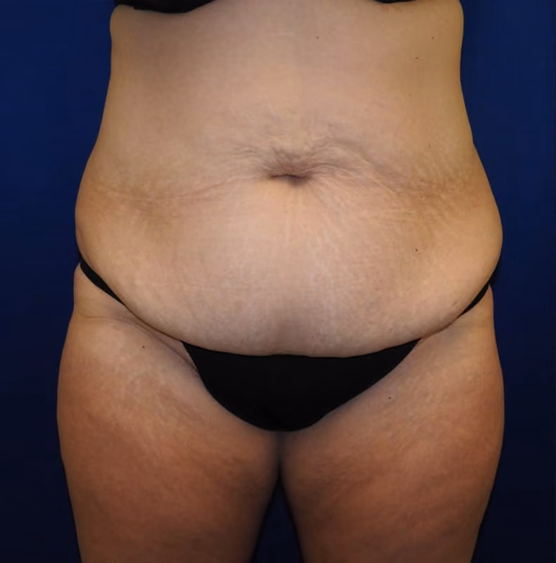 Tummy Tuck before photo, case 7648 - Cool Springs Plastic Surgery
