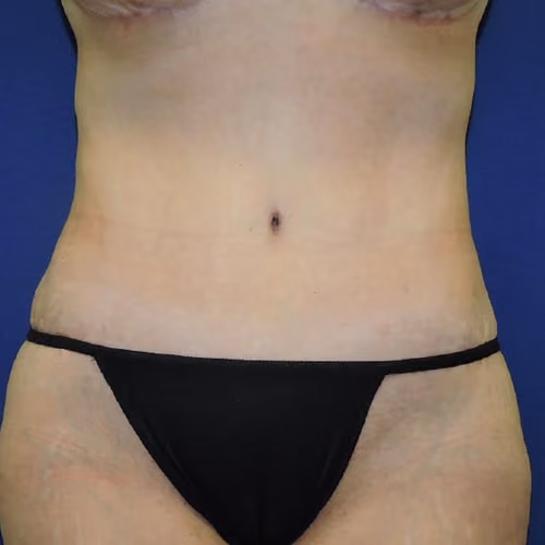 Tummy Tuck after photo, case 7769 - Cool Springs Plastic Surgery