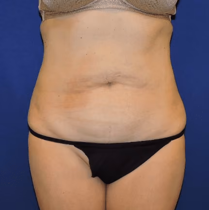 Tummy Tuck before photo, case 7847 - Cool Springs Plastic Surgery