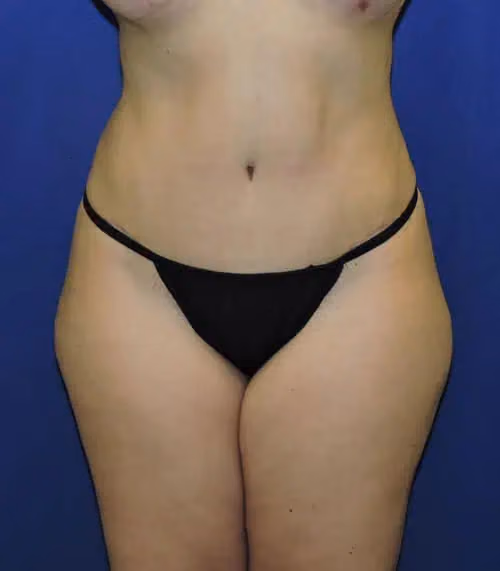 Tummy Tuck after photo, case 8057 - Cool Springs Plastic Surgery