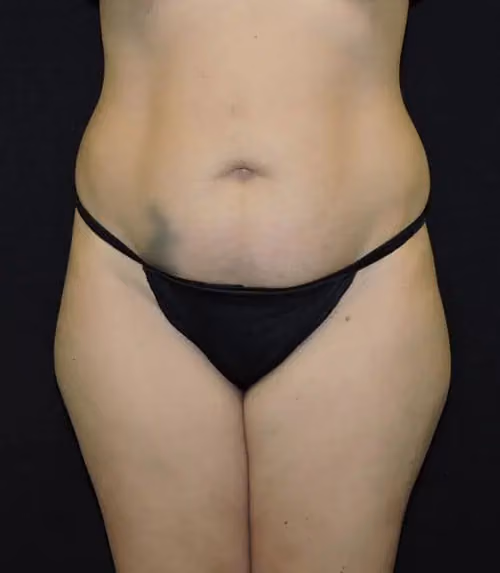 Tummy Tuck before photo, case 8057 - Cool Springs Plastic Surgery