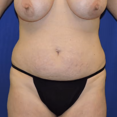 Tummy Tuck before photo, case 8402 - Cool Springs Plastic Surgery