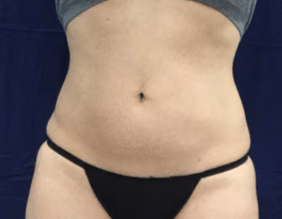 Liposuction before photo, case 6801 - Cool Springs Plastic Surgery