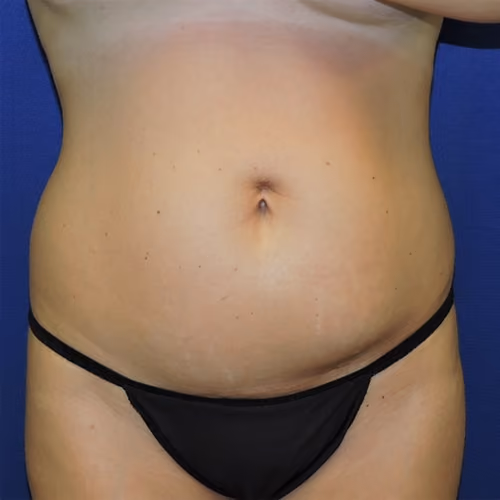 Tummy Tuck before photo, case 8562 - Cool Springs Plastic Surgery