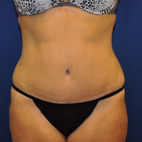 Tummy Tuck before and after, case 8767 - Cool Springs Plastic Surgery