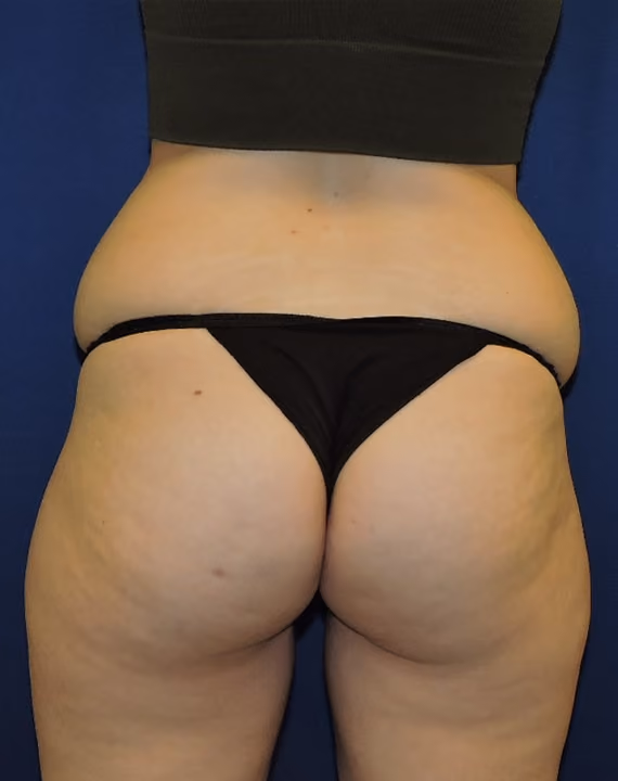Liposuction before photo, case 7130 - Cool Springs Plastic Surgery