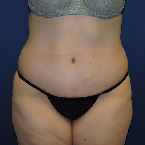 Tummy Tuck before and after, case 9685 - Cool Springs Plastic Surgery