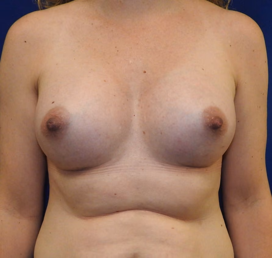 Breast Augmentation before and after, case 8684 - Cool Springs Plastic Surgery