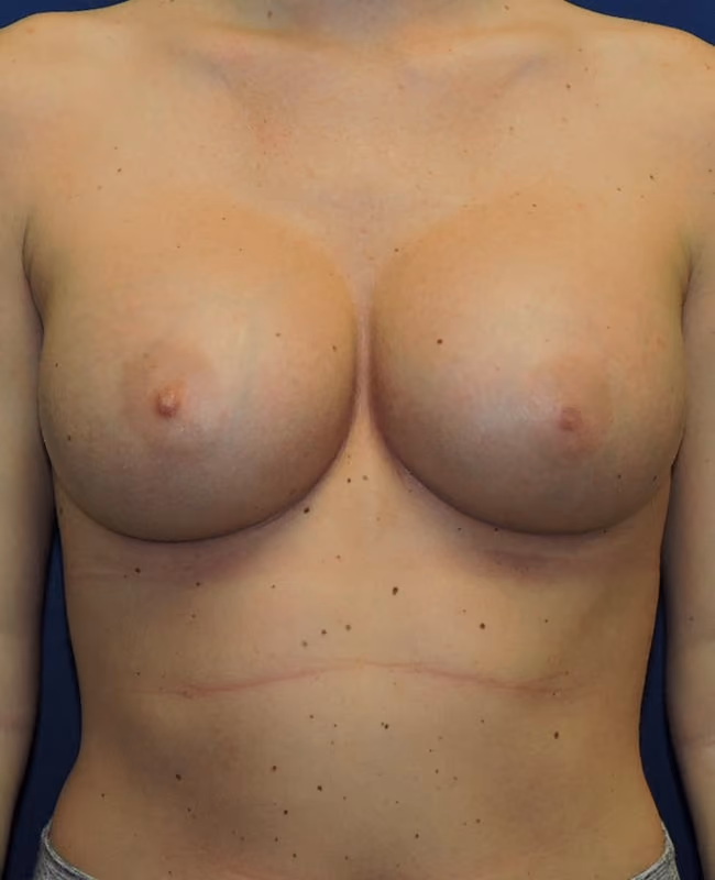 Breast Augmentation before and after, case 8407 - Cool Springs Plastic Surgery