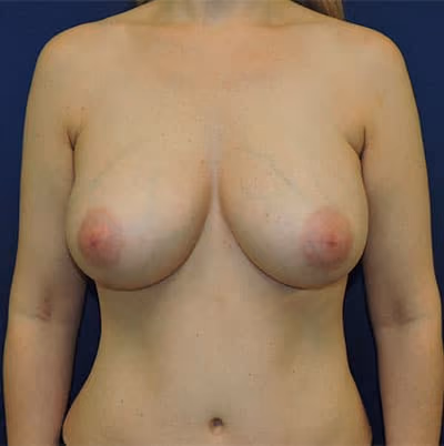 Breast Augmentation before and after, case 8117 - Cool Springs Plastic Surgery