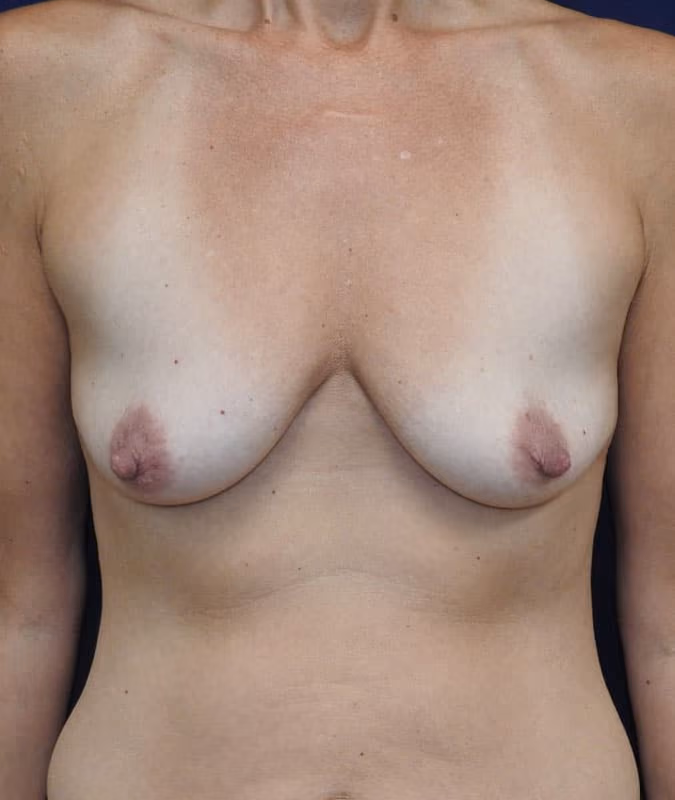 Breast Lift + Augmentation before photo, case 5719 - Cool Springs Plastic Surgery