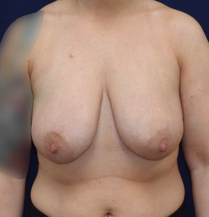 Breast Lift + Augmentation before photo, case 5298 - Cool Springs Plastic Surgery