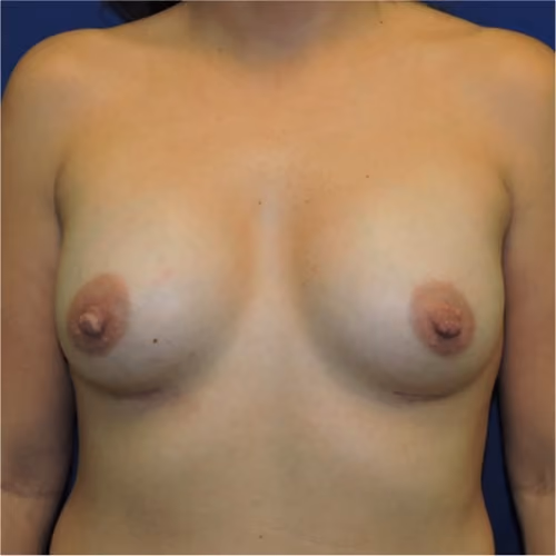 Breast Augmentation before and after, case 7823 - Cool Springs Plastic Surgery