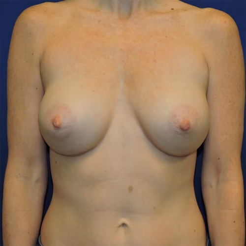 Breast Augmentation before and after, case 7799 - Cool Springs Plastic Surgery